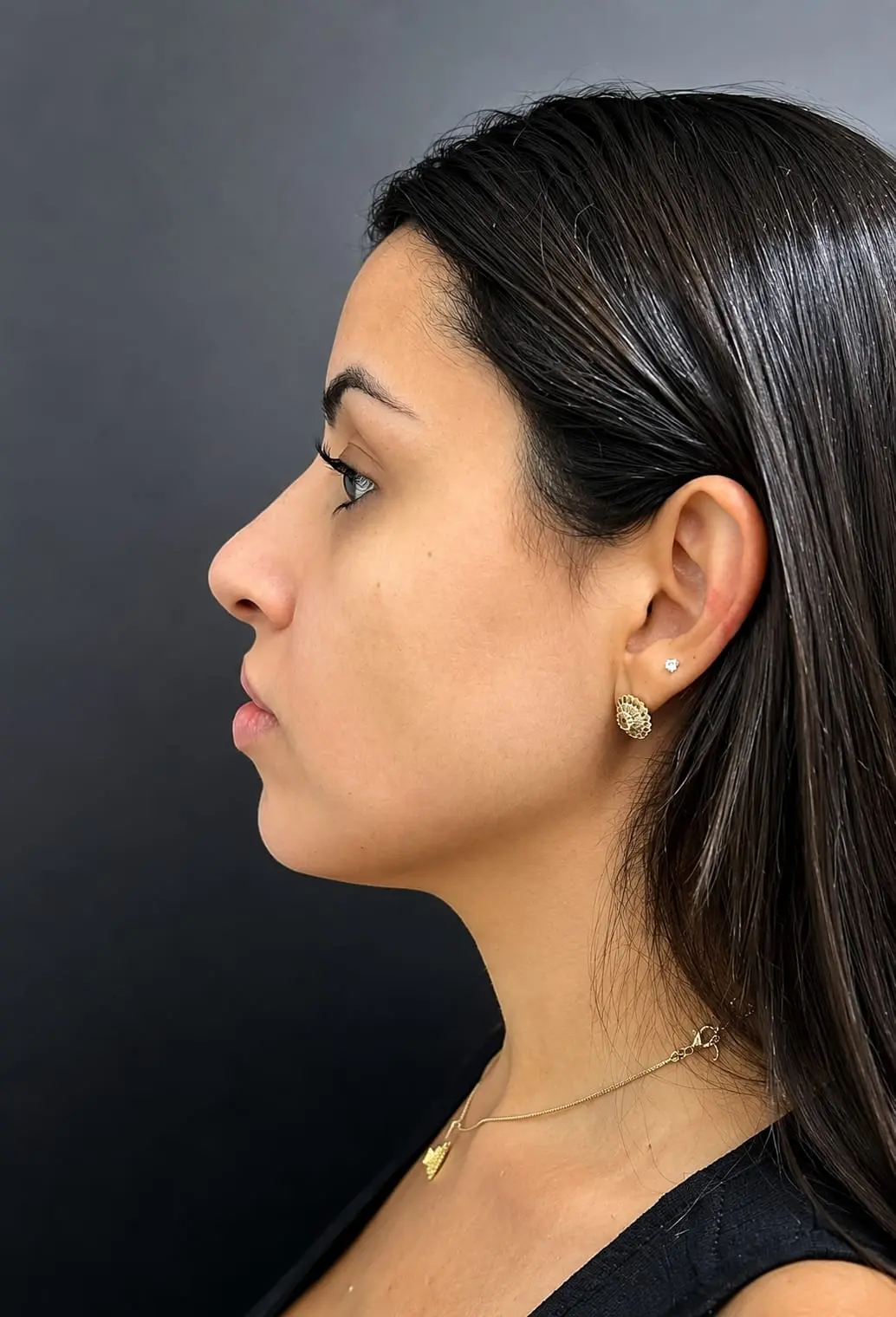 Perfil facial — depois